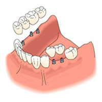 Korona és hídpótlás implantátumon