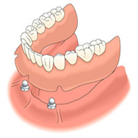 Implantátumon rögzített fogsor