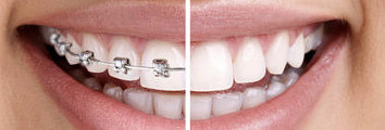 Orthodontic treatments
