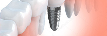 Tooth replacements, implants