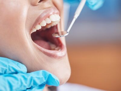 Miért fontos a rendszeres fogkő eltávolítás