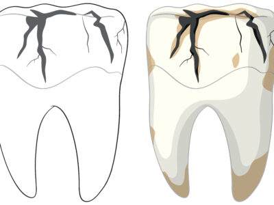 A fogvesztés kockázati tényezői