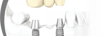 Fogbeültetés, fog implantátum akció