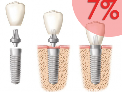 Beszélgetés a fogászati implantátumokról